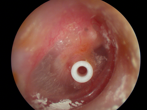 eardrum grommet in situ