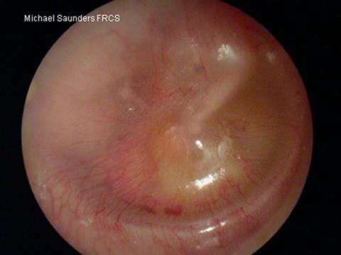 the eardrum showing the presence of middle ear fluid (Otitis Media with Effusion)